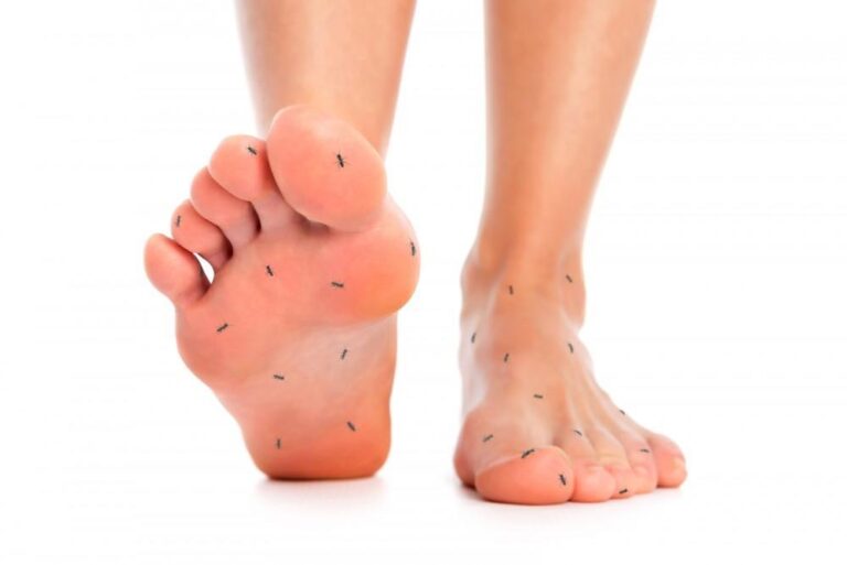 Diabetic Neuropathy
