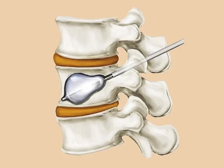 Kyphoplasty