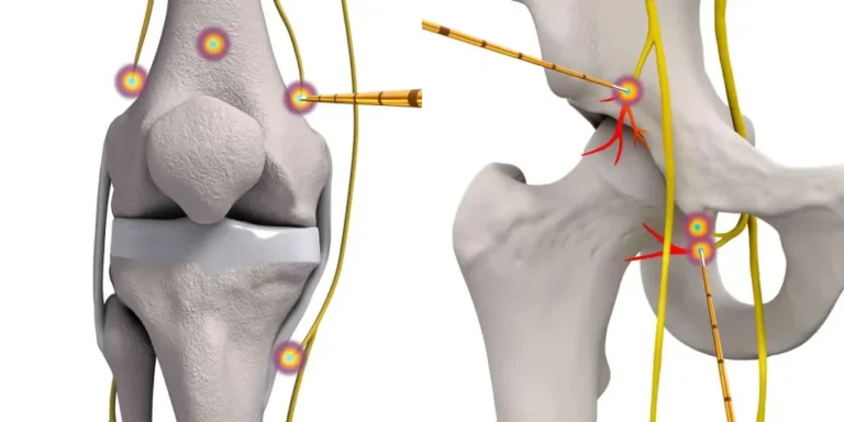 Radiofrequency Ablation