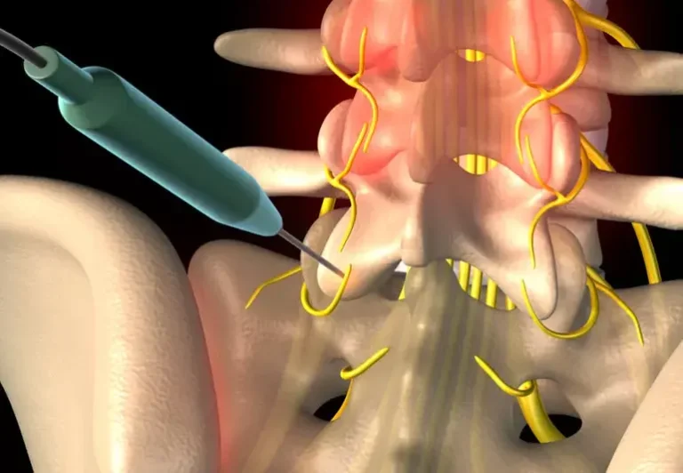 Radiofrequency Ablation