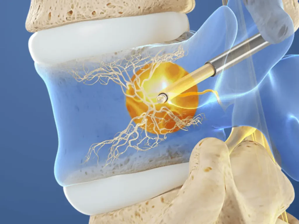 Intracept procedure Chicago